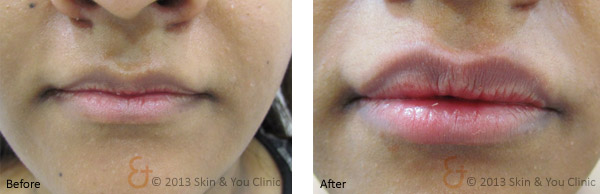 Lip Enhancement Treatment