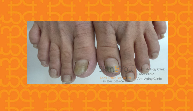 Fungal Nail Infections