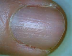 nails in alopecia
