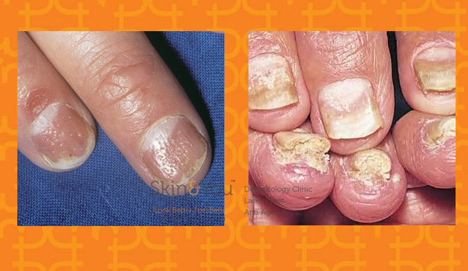 psoriasis-in-nails