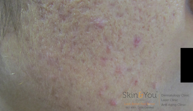 acne-scars-1