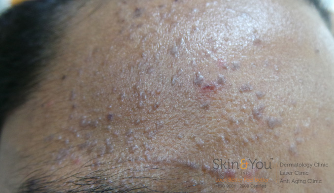 Hpv virus scalp warts